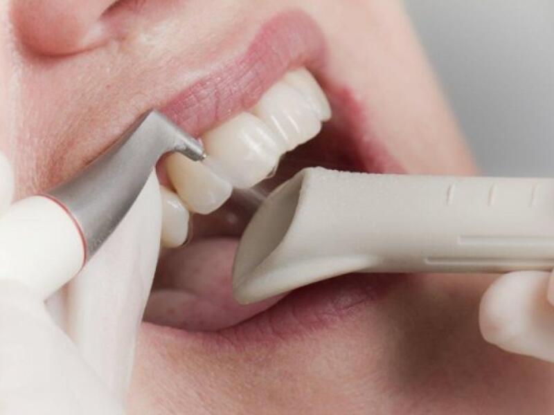 Dental scale and polish in Javea