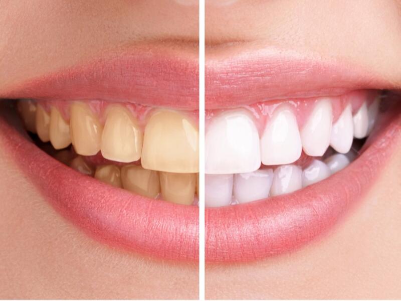 Teeth whitening in Javea - White teeth